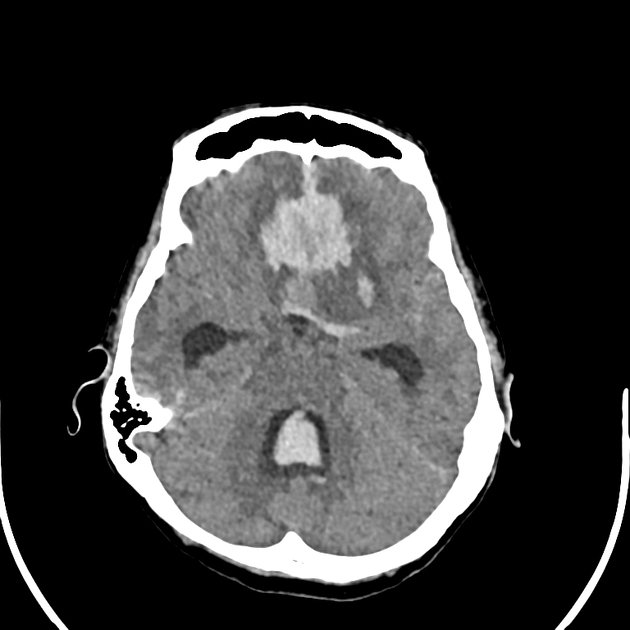 CT of the brain showing haemorrhage from a ruptured aneurysm