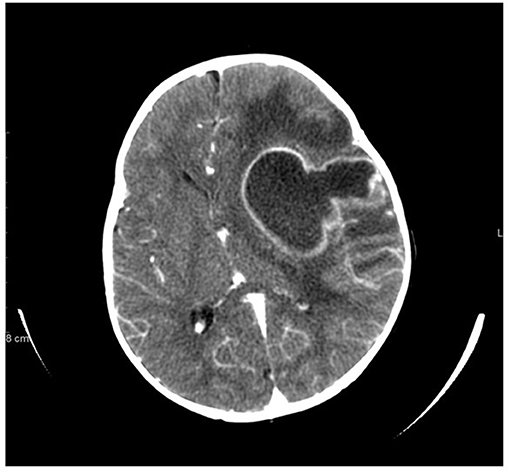 Contrast CT of the brain showing a large ring-enhancing abscess
