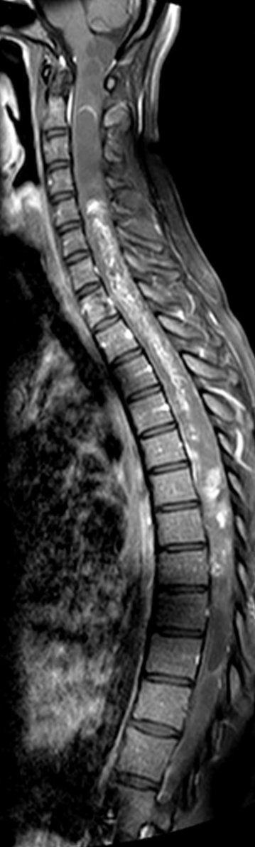 Sagittal MRI of the spine showing an intramedullary tumour along the spinal cord